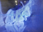 右上親知らずCT.jpg