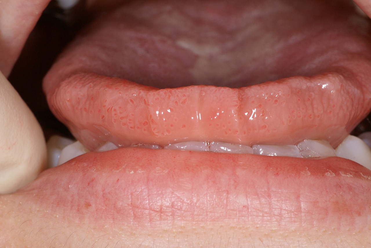 舌 に 歯 の 跡 が つく