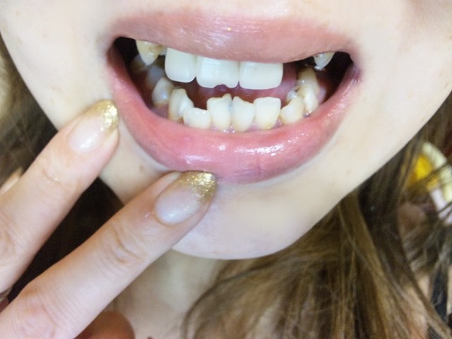 [写真あり] 15年ぶりの歯医者へ・・・27歳、歯がほとんどありません 歯チャンネル歯科相談室