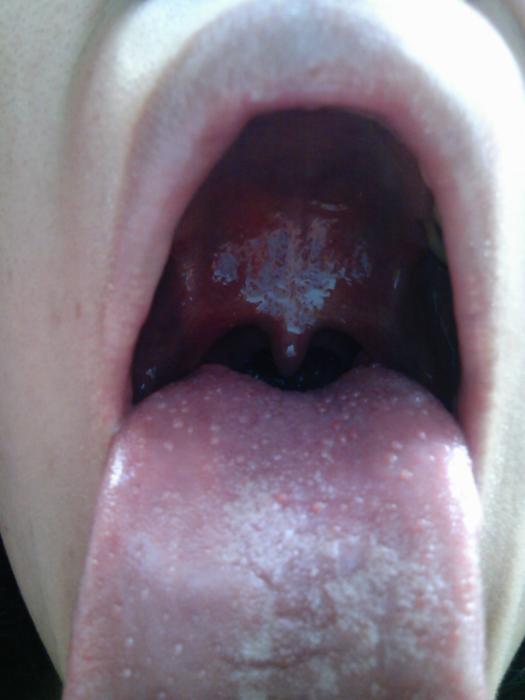 舌 の 奥 に ブツブツ