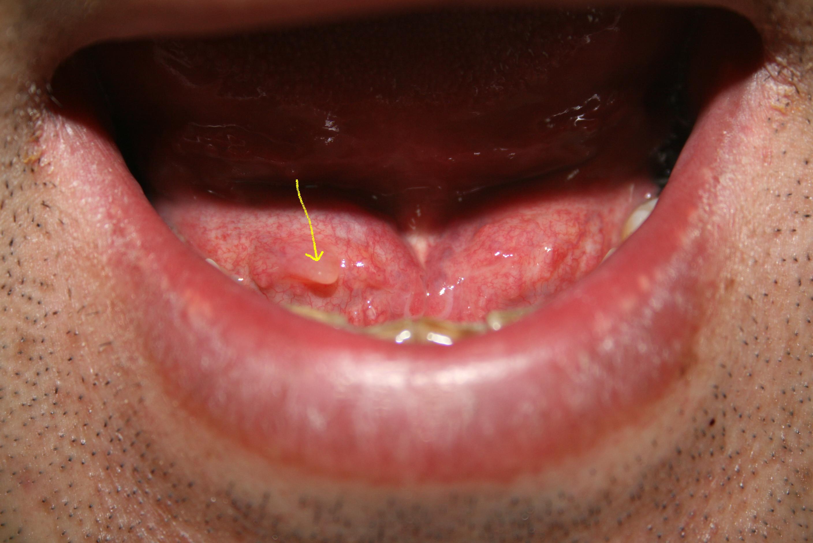舌下腺囊肿手术 2021.8 - 知乎