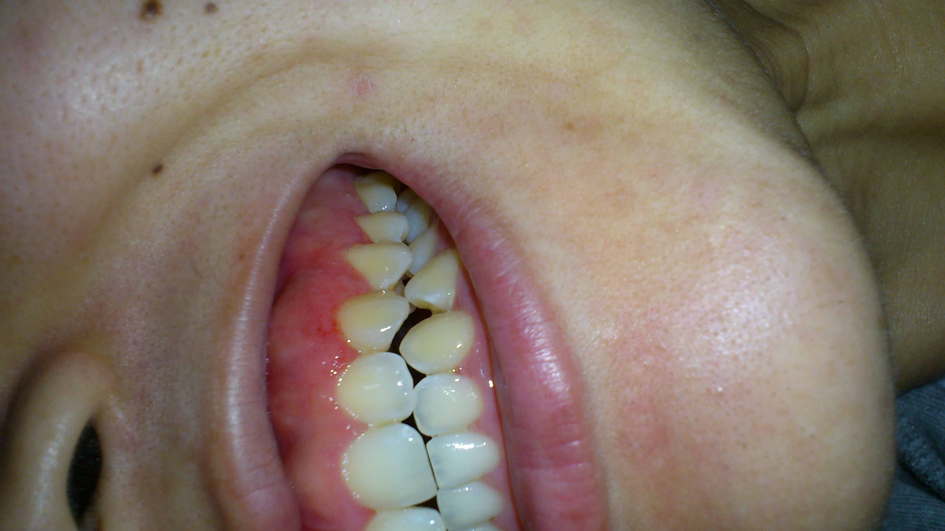 歯茎 の 白い 腫れ