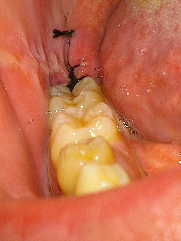 [写真あり] 3日前に親知らず抜歯、縫合部分が開いているように見える 歯チャンネル歯科相談室