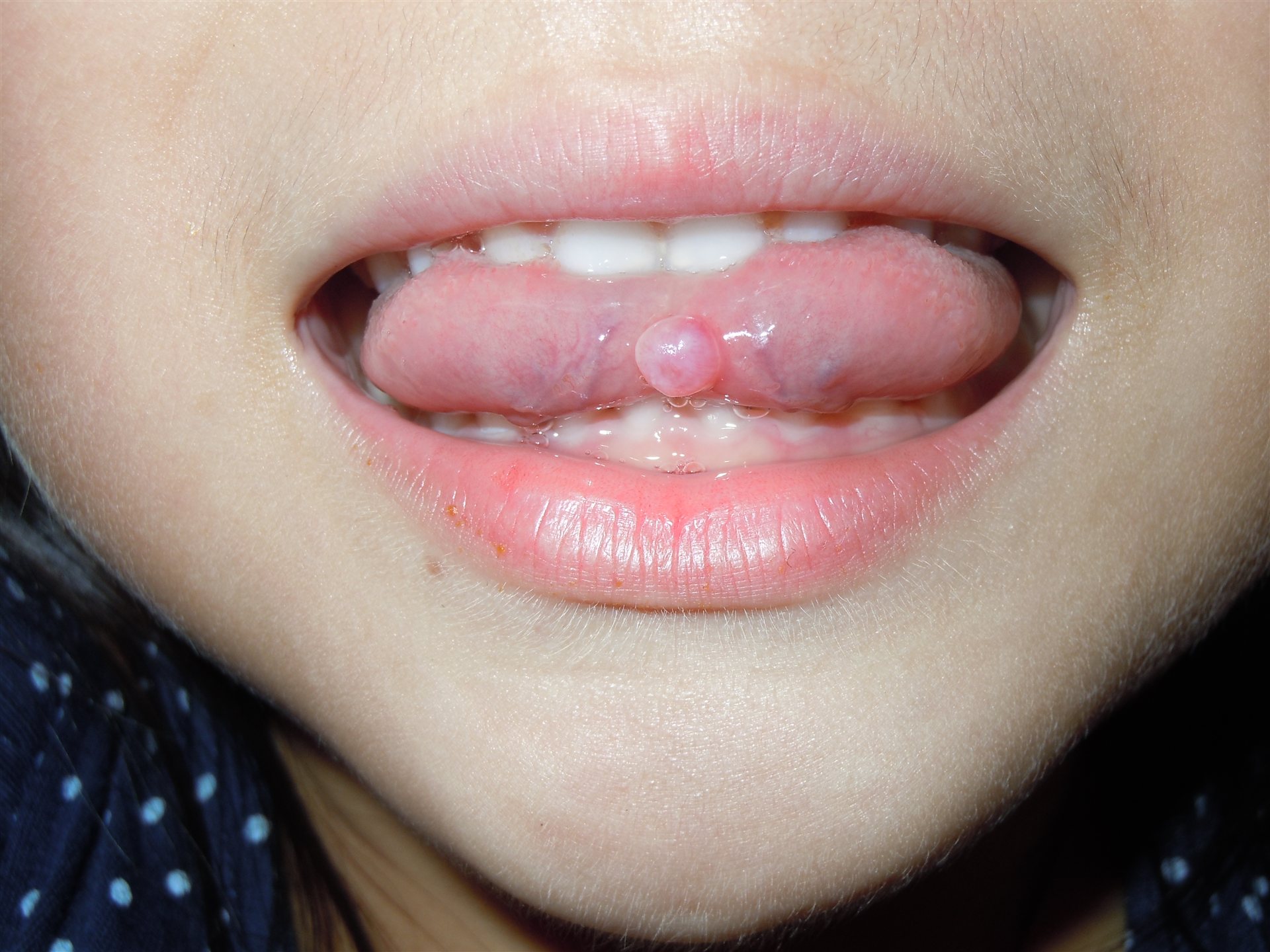 舌头根长泡图片症状,舌头根有个小舌头图片 - 伤感说说吧