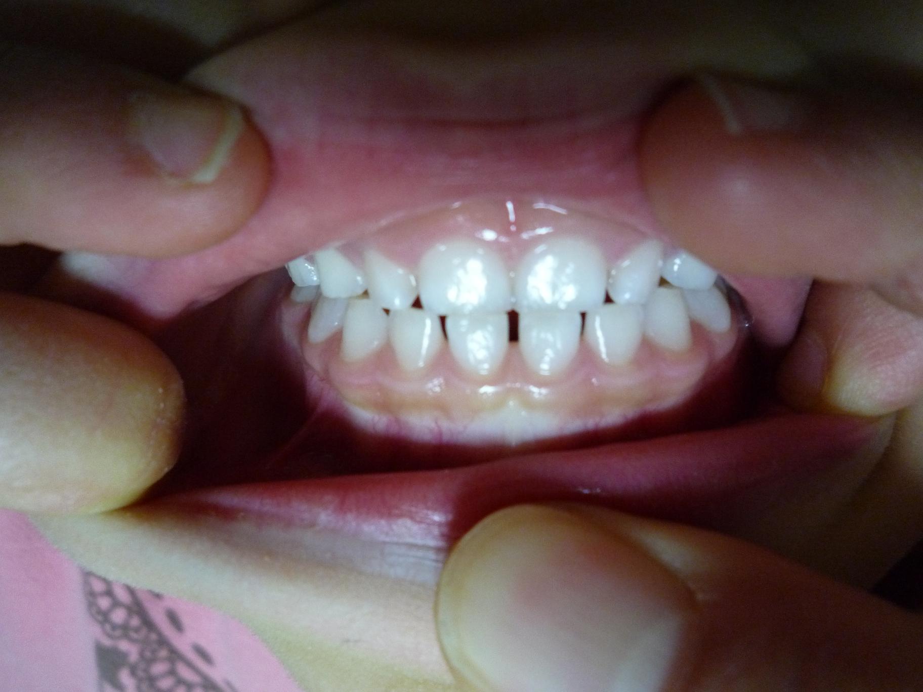 歯 が ツーン と する