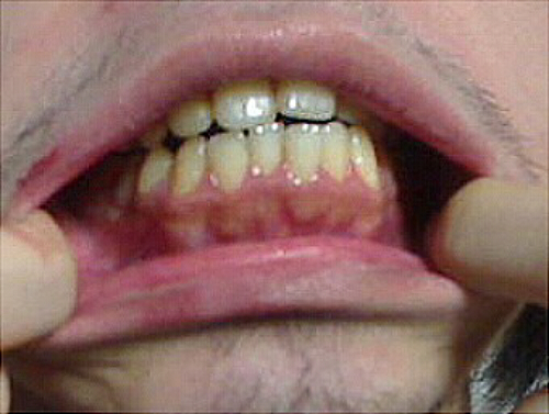 歯茎 歯 が 透け て 見える