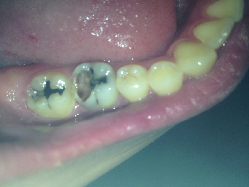 歯 が 欠け た 放置
