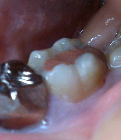 仮 歯 の まま 転院