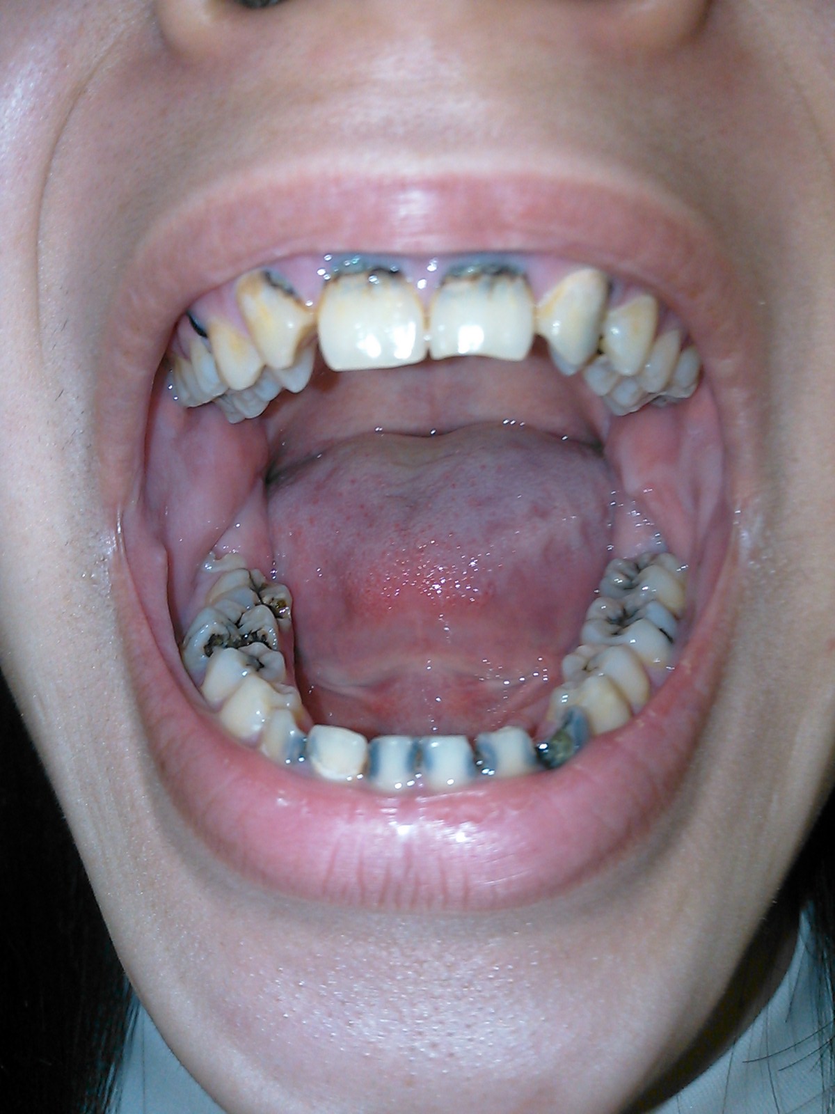 全部 の 歯 が 虫歯