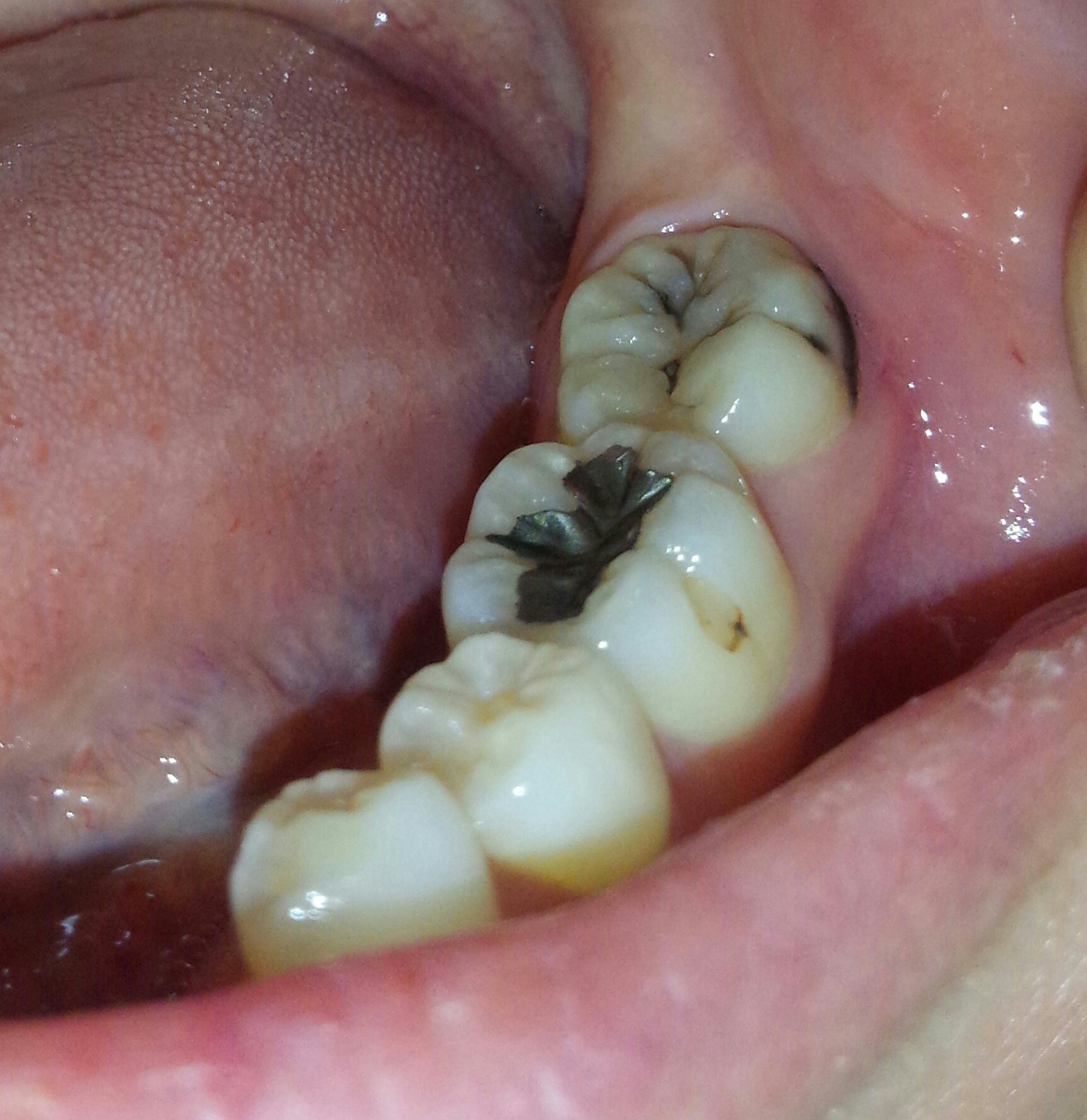 歯 の 生え際 黒い