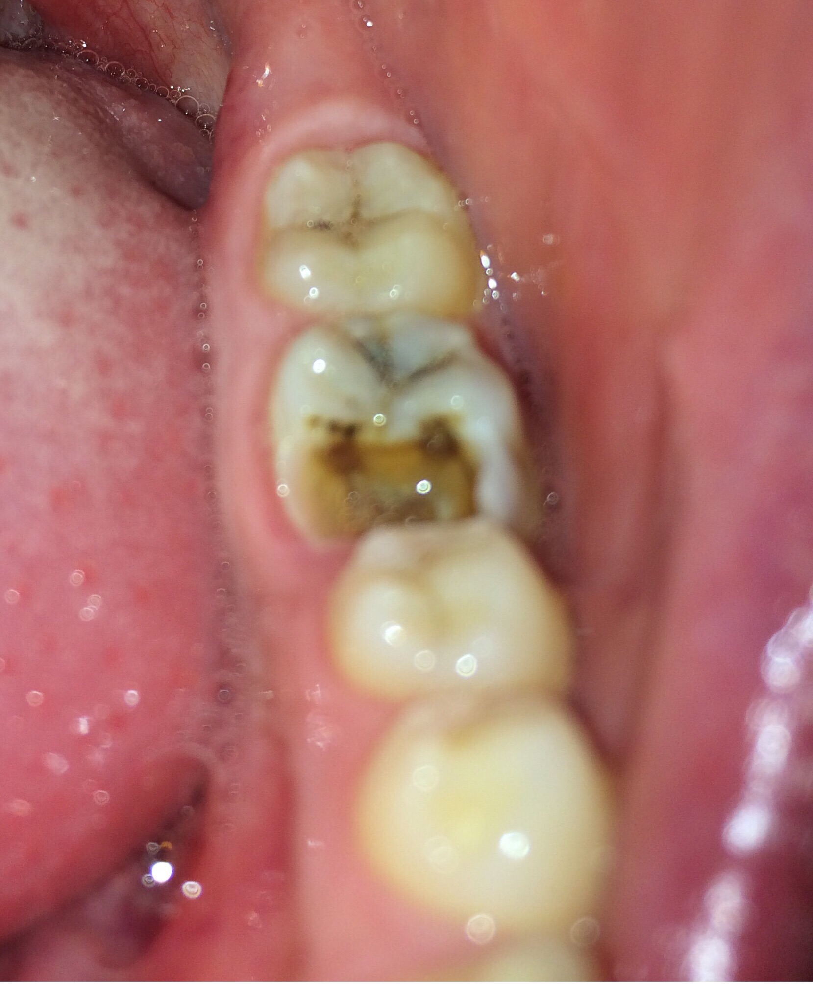 歯 が 欠け た 奥歯