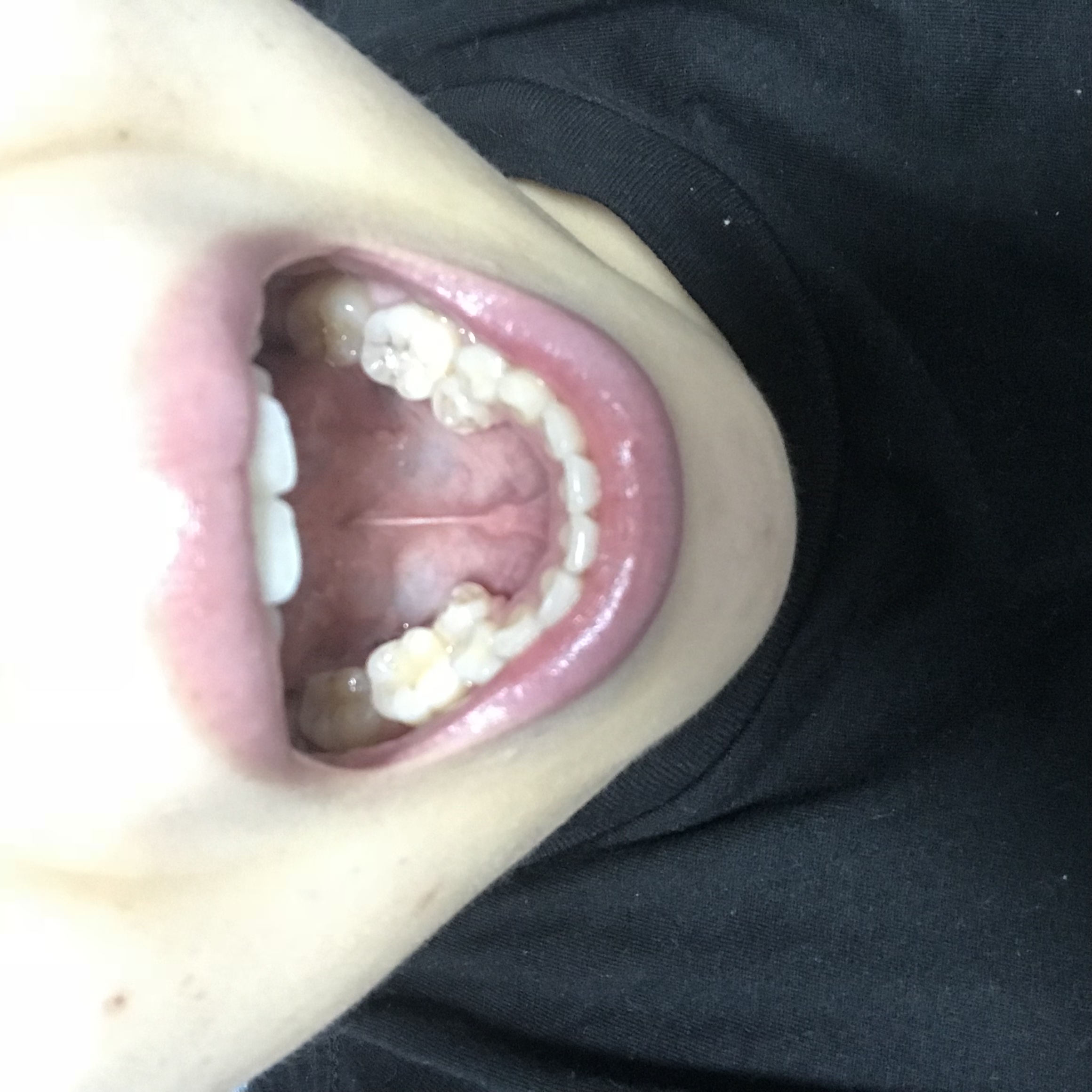 下 の 歯 内側 に 倒れる 原因