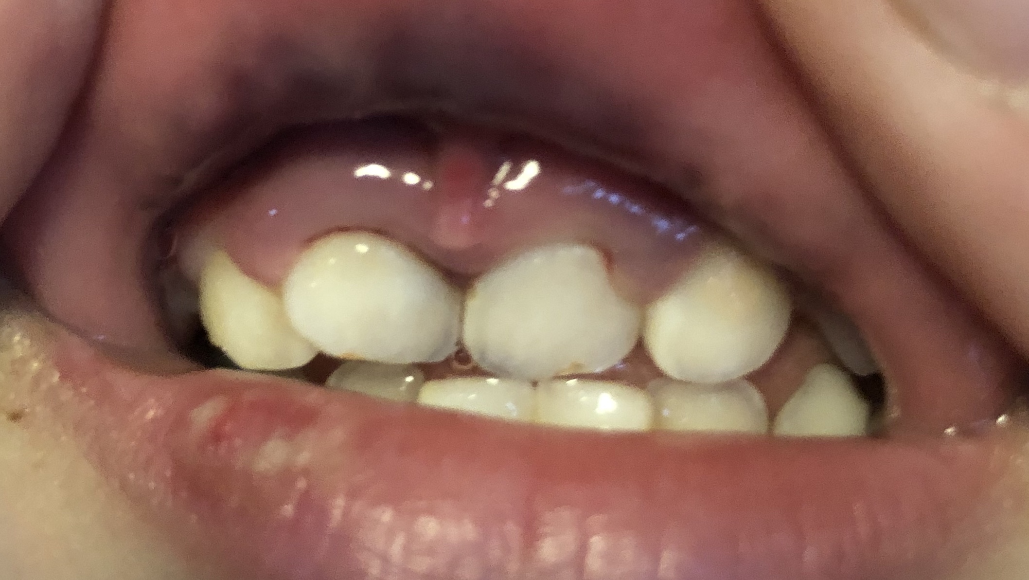 前歯の裏 歯茎 腫れる