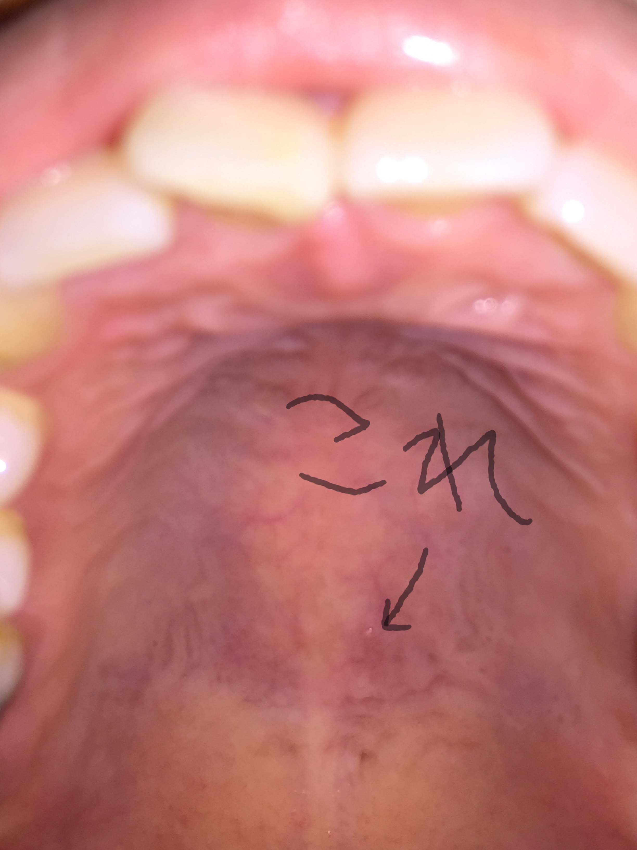 [写真あり] 舌で上顎を触るとプチッとした物ができていて心配 歯チャンネル歯科相談室