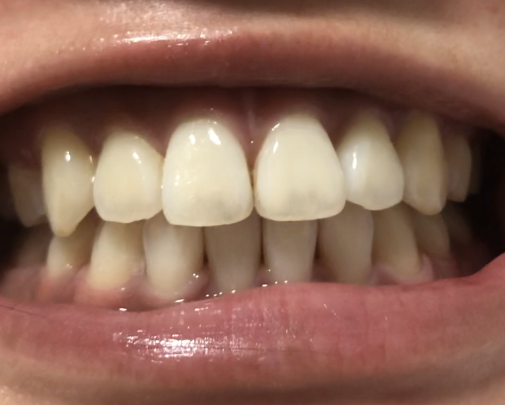 歯 が 透ける 前歯