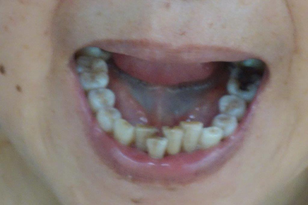 [写真あり] 下前歯が飛び出てきたのは親知らずのせいか？ 歯チャンネル歯科相談室
