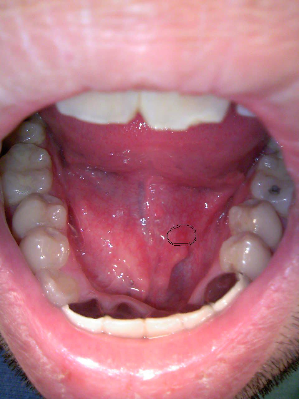 しこり 中 口 の 歯茎に固いしこりが見つかりました。口腔ガンの一種では？
