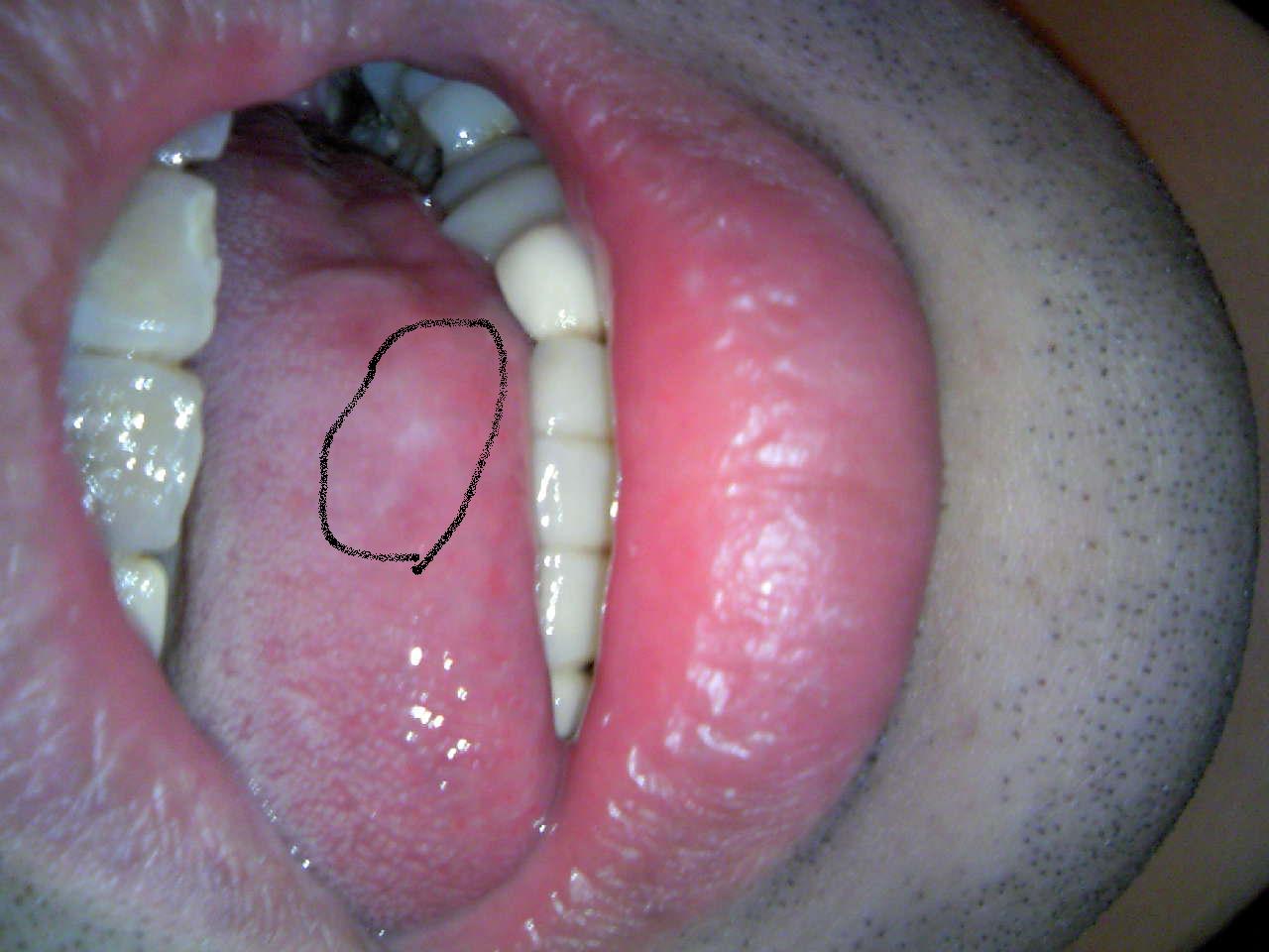 写真あり 舌の側面に白い斑点があります 白板症 前癌状態 歯チャンネル歯科相談室