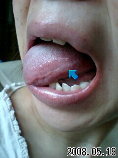 舌 痛い 白い線