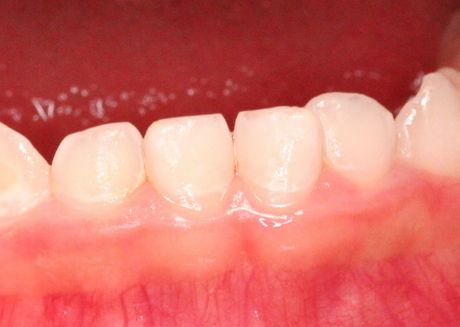子供の歯の白濁 歯医者さんで虫歯ではないと言われたが心配 歯チャンネル歯科相談室