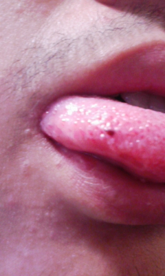 血豆 原因 舌