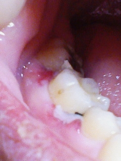 [写真あり] 麻酔で歯茎が内出血し、詰めたインレーもセメントが残っている | 歯チャンネル歯科相談室