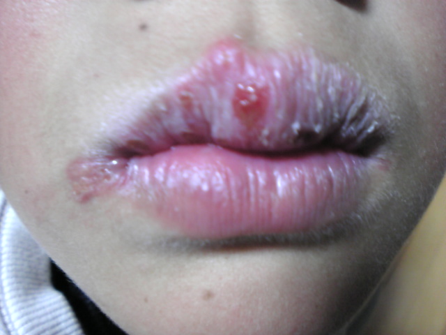 写真あり 子供の唇に水疱ができている 何の病気でしょうか 歯チャンネル歯科相談室