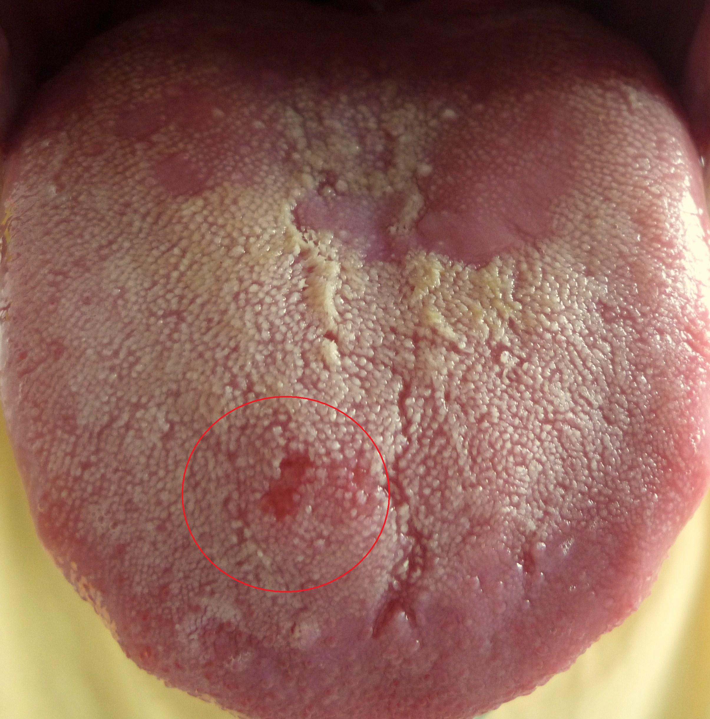 する ヒリヒリ 病気 が 舌 舌が痛い、ピリピリする…更年期以降に起きやすい「舌痛症」との付き合い方