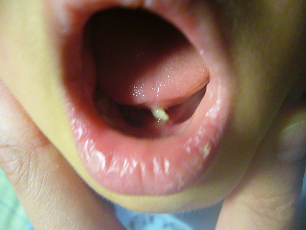 [写真あり] ３歳、舌の裏の筋（舌小帯？）に白い米粒状のできもの