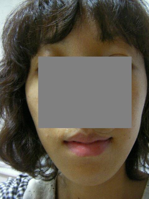写真あり 左右の顎の角度が違うのは顎変形症でしょうか 歯チャンネル歯科相談室