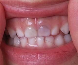 写真あり ３歳 ぶつけた前歯の色が黒くなった 永久歯への影響は 歯チャンネル歯科相談室
