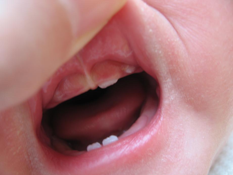 写真あり ７ケ月の乳児 歯の生え方 生える順番が心配 歯チャンネル歯科相談室