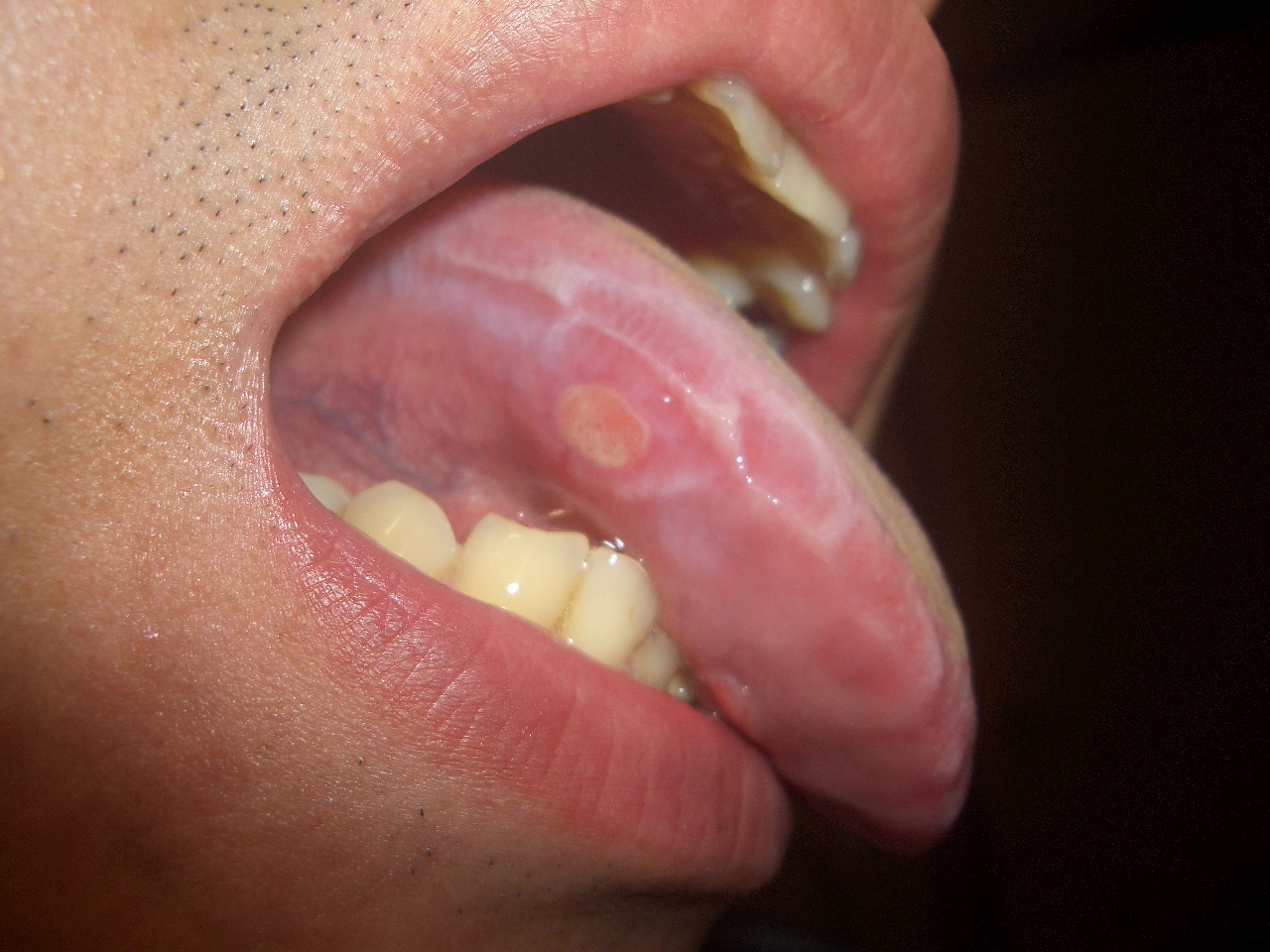 写真あり 舌の血豆を潰したら口内炎になり全体的に白い筋状のできもの 歯チャンネル歯科相談室