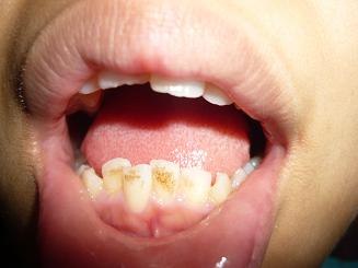 写真あり ここ２ ３年で歯が茶色に汚れてきました 歯チャンネル歯科相談室
