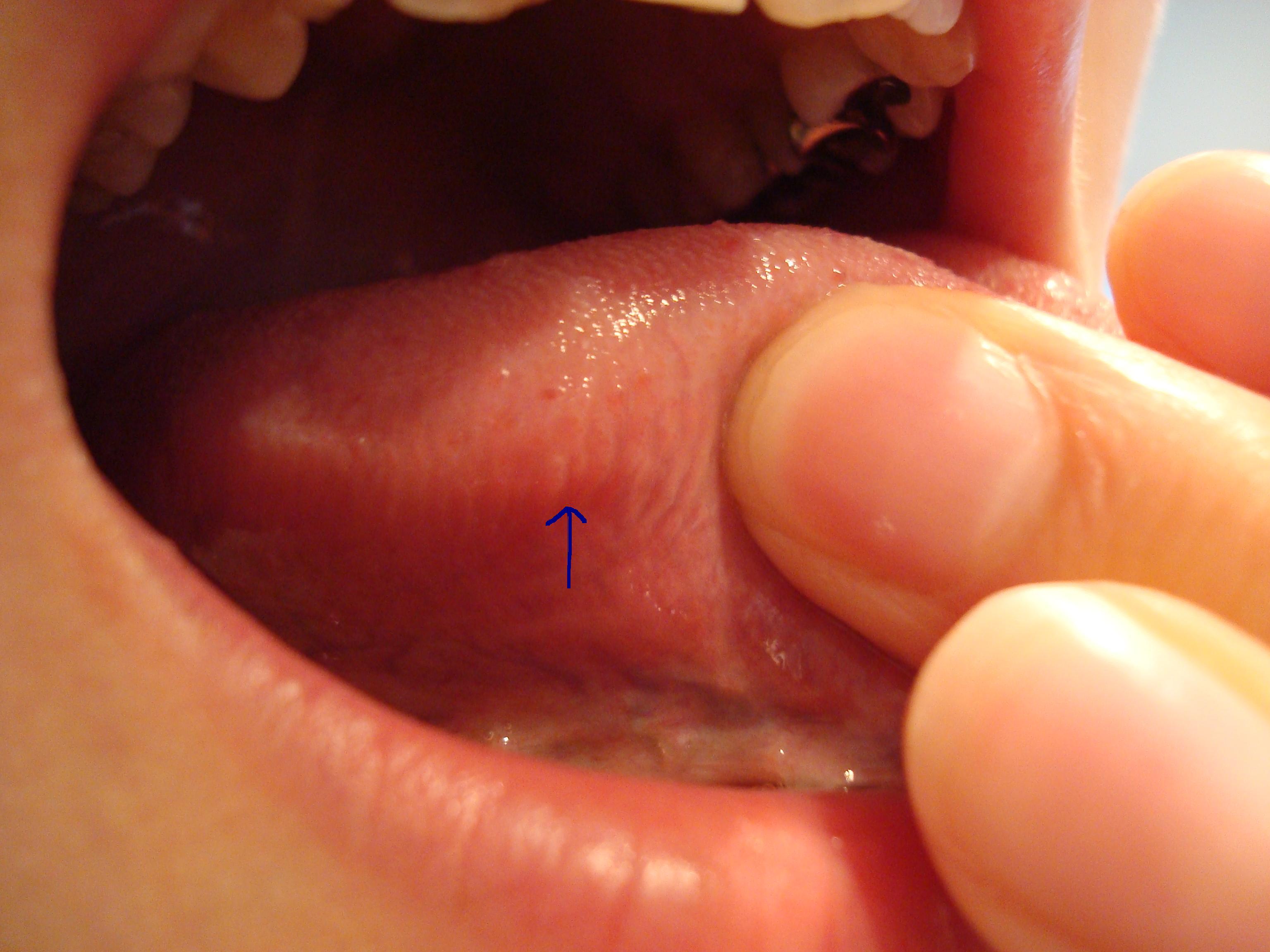 痛い 舌 舌の側面が痛い９つの原因とは！病気の可能性も・・