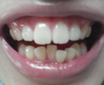 写真あり 過食嘔吐による酸触歯ですが歯列矯正は可能ですか 歯チャンネル歯科相談室