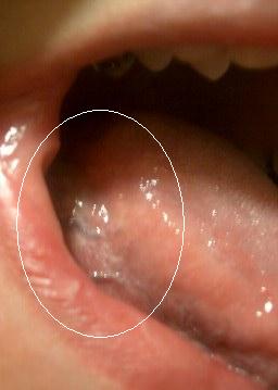 写真あり 舌に痛みがあり奥には白い線のようなもの 歯チャンネル歯科相談室