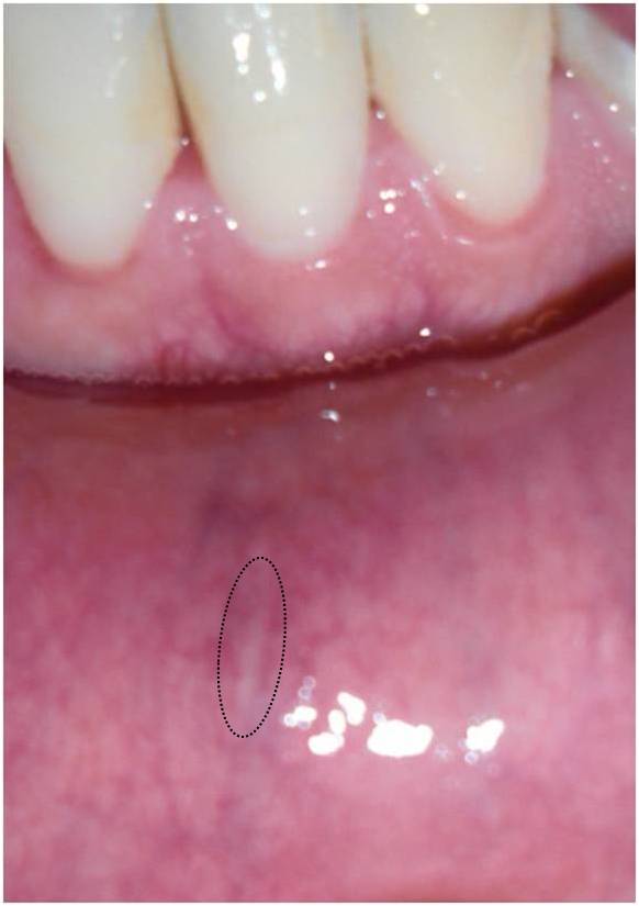 写真あり 唇の裏の白い縦筋 海外 歯チャンネル歯科相談室