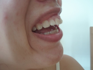 写真あり 出っ歯とガミースマイルで笑うと口角が上がらず不自然です 歯チャンネル歯科相談室