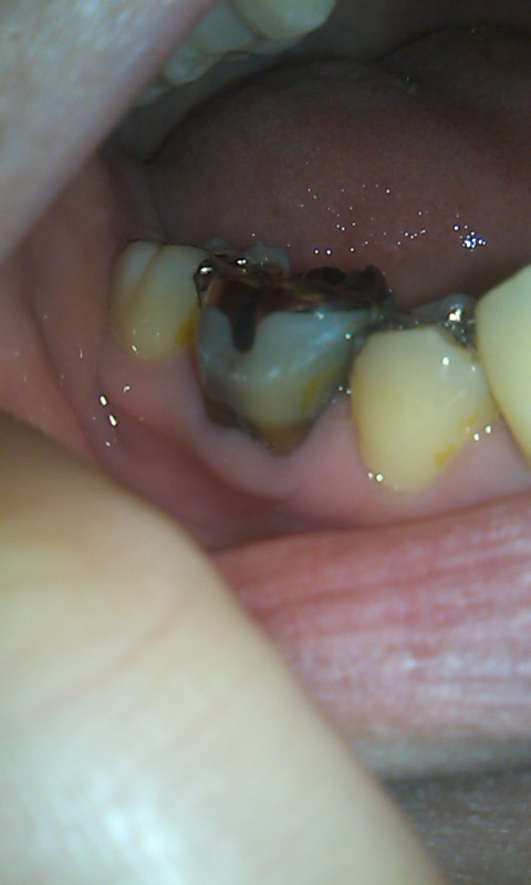 写真あり クラウンを被せた歯の根元が黒いのは虫歯でしょうか 歯チャンネル歯科相談室