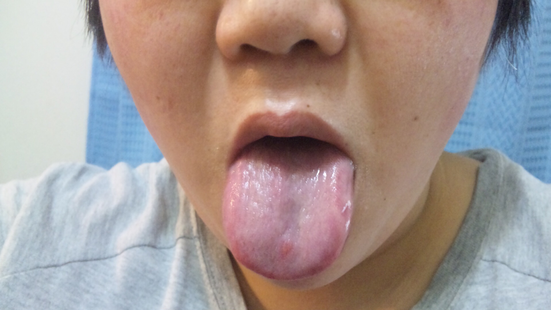 舌 が 腫れ ぼっ たい