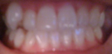 写真あり 八重歯の矯正と一緒に 正中や歯の長さも綺麗にできる 歯チャンネル歯科相談室