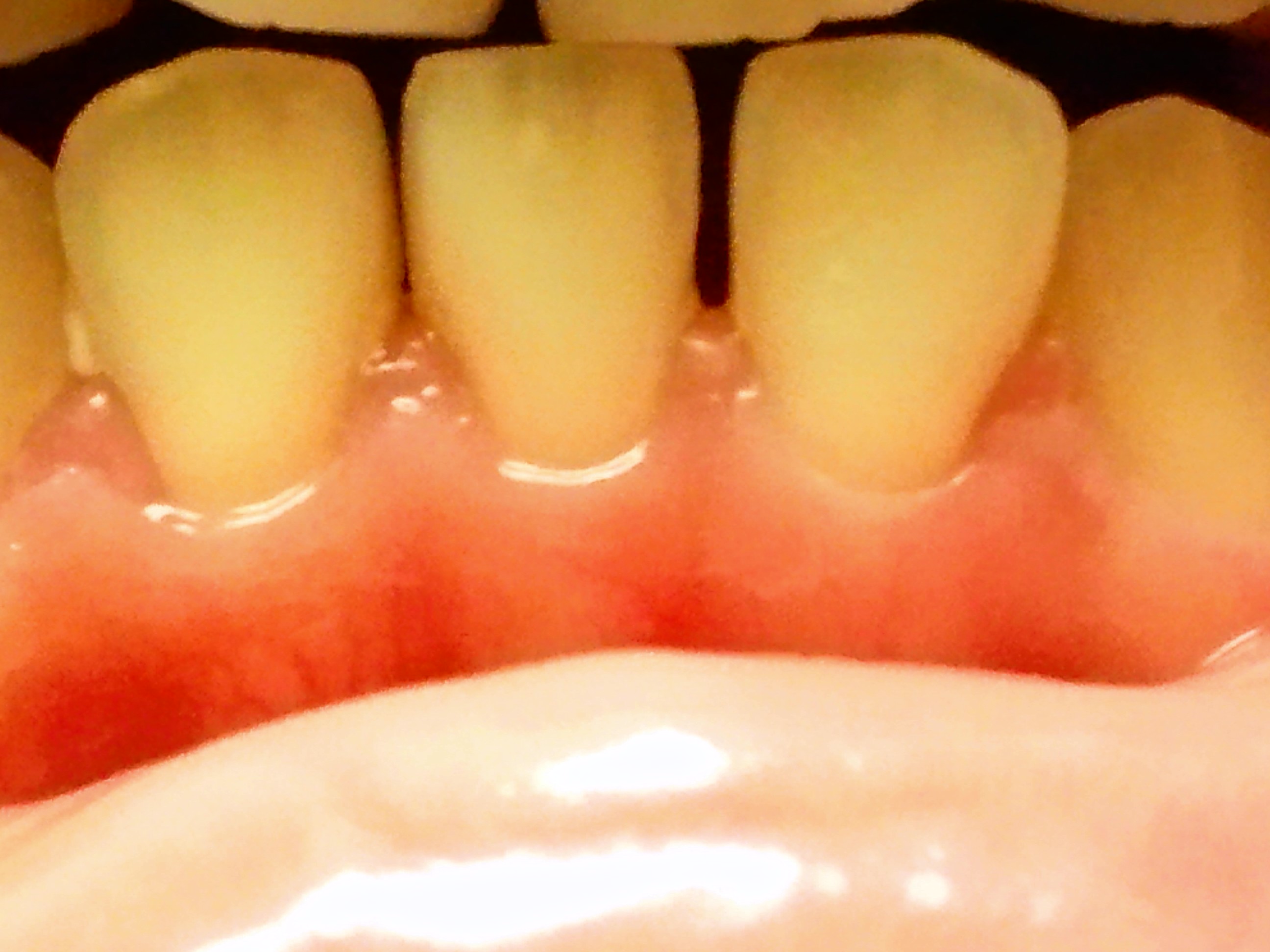 有声歯・歯茎側面はじき音