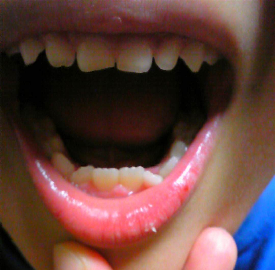 写真あり ７歳 乳歯の間隔が狭く生えてきた永久歯が斜めに 歯チャンネル歯科相談室