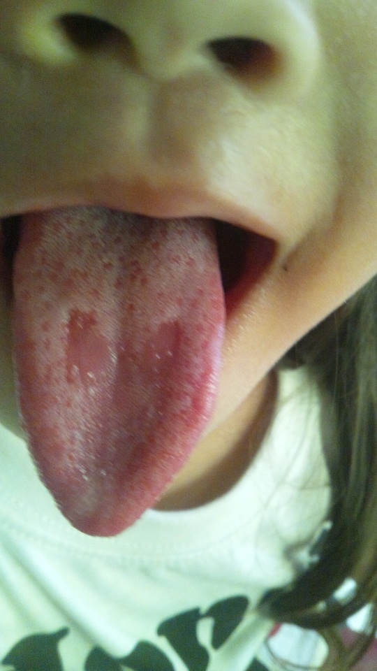 舌 に 丸い 模様
