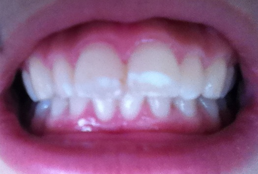 写真あり 小さい頃から前歯の表面に大きな白い斑点があります 歯チャンネル歯科相談室