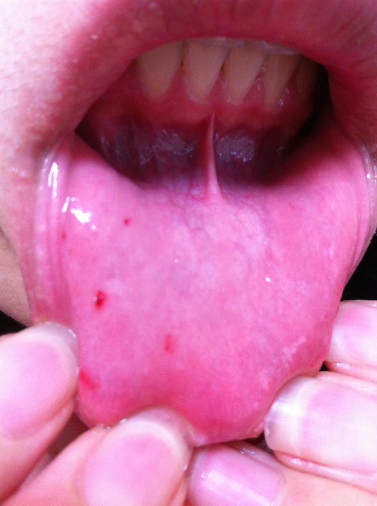 写真あり 下唇内側に赤い点々のようなものができています 歯チャンネル歯科相談室
