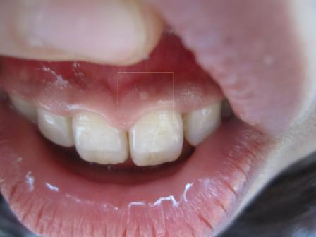 に もの 歯茎 白い でき 歯茎におでき!!その正体・できる原因、治療方法、放置すると・・・？