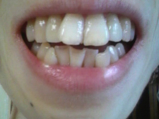 写真あり 過食嘔吐で歯がもろくなった 嘔吐直後のうがいの効果は 歯チャンネル歯科相談室