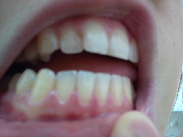 写真あり 歯茎が下がっているのは過食嘔吐を繰り返したから 歯チャンネル歯科相談室